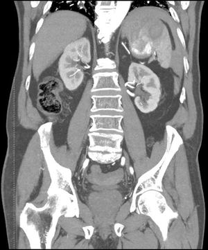 Coronal CT scan showing splenic rupture with active bleeding.