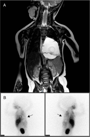 (A) Thoracoabdominal MRI showing a large mass in the posterior mediastinum and left paravertebral area. It is causing deviation of the esophagus and gastroesophageal junction, with no evidence of distant; (B) 123I-metaiodobenzylguanidine scintigraphy, performed 4h post-injection of the radiotracer, showing a cold area with zero tracer uptake in the left hemithorax, corresponding with the tumor mass (arrows) and ruling out neuroblastoma.