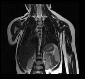 Follow-up thoracoabdominal MRI performed 9 months after surgery. No mass remains are observed, and there are no areas of signal alteration in the surgical bed of the left hemithorax. Mediastinum shows no deviation and no compression of the airway.