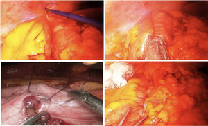 Use of barbed suture in right laparoscopic hemicolectomy.
