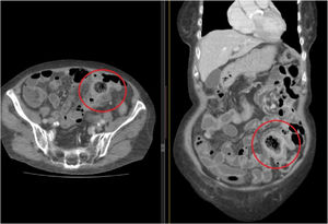 Axial and coronal CT scans showing intestinal thickening and a collection of gas inside.