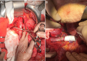 (A) Vascular clamping of the retrohepatic vena cava, origin of the left renal vein and confluence of the right renal vein prior to cavectomy and en bloc resection with the right adrenal gland. (B) Vascular reconstruction using a ringed PTFE graft and direct re-implantation of the left renal vein (yellow arrow); origin of the right renal vein at the resection edge (green arrow).
