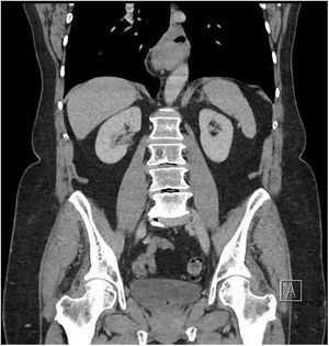 Thoracoabdominal CT that evidences hiatal hernia.
