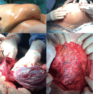 Incisional hernia with uterus inside, delivery and placement of preaponeurotic mesh.