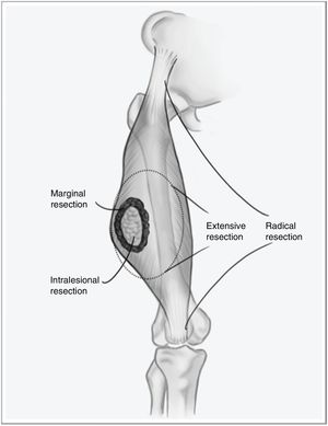 Types of resection in soft tissue sarcomas.