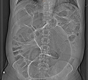 This image demonstrates the great distension of the colon, possibly compatible with a picture of infectious colitis.