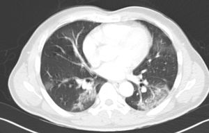 Image of organizing pneumonia with bilateral multilobar ground-glass opacities, predominantly in the lower lobes.