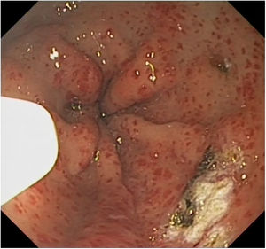 Endoscopic findings: GAVE.