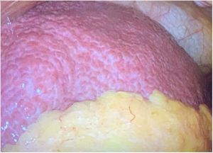 Intraoperative findings: liver cirrhosis.