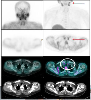 Comparison between imaging study with scintigraphy and MIBI SPECT/CT (left column) and PET/CT with 18F-fluorocholine (right column) in a patient affected with PHPT and negative conventional tests with MIBI.