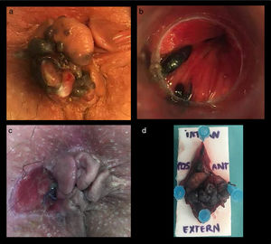 a) Anal examination with pigmented skin tags; b) Pigmented mucosal lesions visible by anoscopy; c) Result of local excision; d) Surgical specimen with retracted margins.