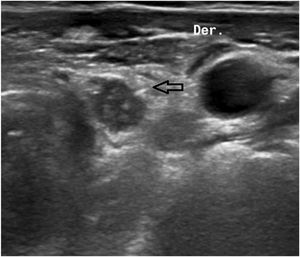 Identification of the seed by ultrasound.