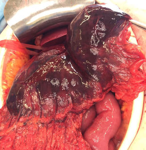 Massive gastric ischemia showing edema and necrosis.