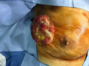 Indurated and ulcerated exophytic mass, measuring some 5 × 6 cm in the right breast.