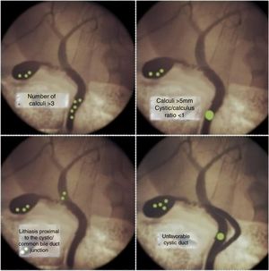 Unfavorable situations for the treatment of biliary lithiasis.