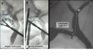 A) Unfavorable cystic duct (twisted); B) Proximal dissection of the cystic duct; C) Angular cysticotomy. TCI: transcystic instrumentation.