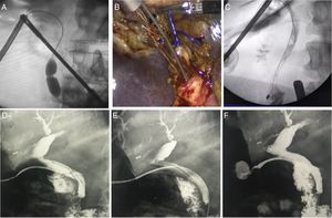 A) Progressive anterograde papillary dilatation controlled with percutaneous balloon; B and C) Wire and basket snare in tandem; D–F) Sequence of extraction with T-tube and guidewire.