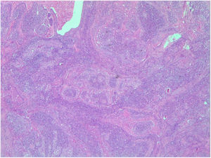Solid and papillary structures of oncocytic cells in lymphoid stroma (H&E × 10).