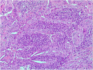 Papillae of oncocytic type cells with lymphoid stroma; two optically empty nuclei are observed as in the classical variant (H&E × 40).