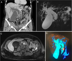 (a) Abdominal CT with intravenous contrast (coronal plane reconstruction). Hydropic gallbladder and dilation of the intrahepatic bile duct and common bile duct (23mm), with a sudden change in caliber at the level of the papilla of Vater; (b and c) MRCP showing a markedly dilated bile duct with an abrupt change in caliber in the distal-prepapillary common bile duct, coinciding with the presence of a nodular lesion measuring 17mm that was enhanced after the administration of contrast that could correspond with ampullary cancer (b: coronal MIP reconstruction and c: axial T1-FS image with iv contrast in arterial phase); (d) reconstruction using Myrian® software from Intrasense® showing the enlarged gallbladder and dilated bile duct in light blue and the ampullary lesion in orange.