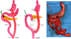 (a) Diagram of the preoperative anatomy: RYGB and ampullary lesion; (b) postoperative anatomical reconstruction; (c) surgical specimen of the pancreaticoduodenectomy and gastrectomy of the gastric remnant.