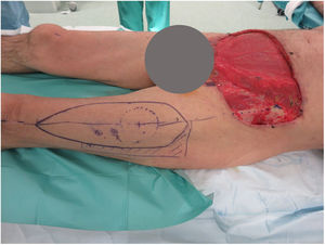 Lower abdominal defect measuring 24 × 17 cm, including pre-rectal fascia, after 5 sessions of Mohs surgery; design of the anterolateral flap of the left thigh.