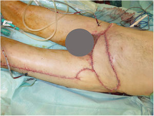 Immediate result of the abdominal reconstruction with a pedunculated anterolateral thigh flap and direct closure of the harvested area.