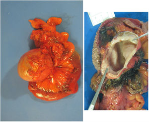 Small intestinal segment presenting a cystic mass in the mesentery, measuring 8.5 × 6 × 6 cm, and content with a chocolate-looking appearance.