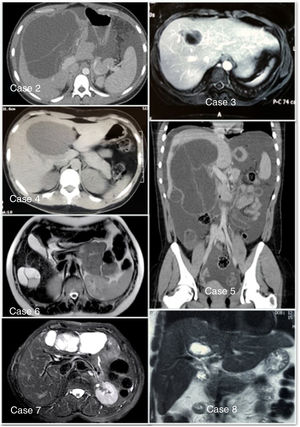 Radiological images of patients with intrahepatic cystic neoplasm. (In cases 1, 9 and 10, the images could not be obtained.)