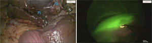 Temporal occlusion of the portal pedicles of segments IVb and V; outline of ischemia using indocyanine green.