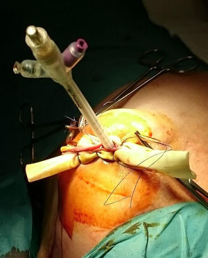 Application of IORT: coverage of the balloon by breast tissue and skin; dermal protection of the suture with Penrose surgical drains.