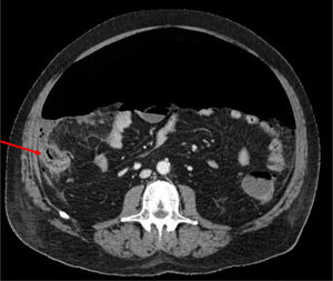 Axial computed tomography image with contrast of the patient showing abundant pneumoperitoneum and inflammatory changes in the cecum (red arrow), a finding that suggests cecal perforation.