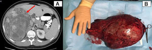A) A heterogeneous mass measuring 15×20×29cm occupying the right hypochondrium and flank, probably adrenal in origin (identified with an arrow); B) Oval, encapsulated surgical piece measuring 35×20cm that corresponded with the tumor mass described in the imaging tests, originating in the right adrenal gland.