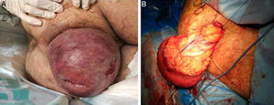 (A) Large incarcerated rectal prolapse: congestive mucosa with necrotic areas and ulceration; (B) surgical intervention: after circumferential incision at the pectinate line, excision of the prolapsed rectum.