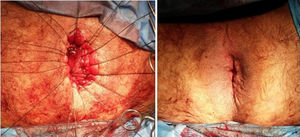 Result of the surgical procedure, with manual coloanal end-to-end anastomosis.