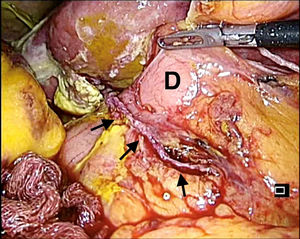 Diverticulectomy. Biliar peritonitis. It shows the stapler line of diverticulectomy (arrows). D: duodenum.