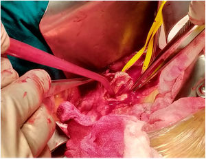 Arteriotomy with extraction of the device and closure of the defect with correction of the dissection using a bovine pericardial patch.