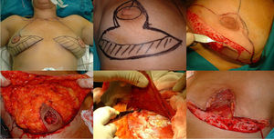 Mastectomy phase: a) Marking the pattern; b) Inclusion of the biopsy scar within the area to be resected; c) De-epithelization of the area that will be the lower dermal fat flap; d) Excision and preservation of the NAC; e) Mastectomy releasing adhesions to the muscle; f) Result after complete excision of the gland.