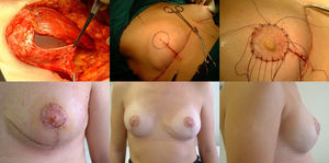 Reconstruction phase: a) Placement of the implant that will be covered by the pectoralis major muscle (upper 2/3), sutured to the dermal fat flap (covering the lower 1/3); b) Marking the area for the new NAC once sutured to the skin pattern; c) Free NAC graft in its new position; d) Result after seven days; e) Result after one year; frontal view; f) Result after one year; lateral view.