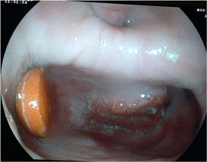 Endoscopic image of the Zenker diverticulum cavity, with a tablet inside and a suspicious lesion on the anterior side.