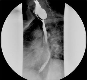 Barium swallow done during follow-up, where a Zenker diverticulum is observed.