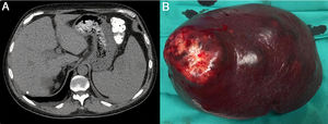 (A) Abdominal CT without intravenous contrast showing a large spleen with several hypodense lesions; (B) Splenectomy piece measuring 22×16×7.5cm and weighing 1.1kg, with a whitish umbilicated nodule on the surface.
