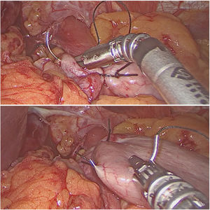 Intracorporeal suture for Nissen fundoplication using FlexDex®.