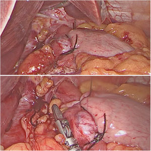 Final result after intracorporeal suture using FlexDex® to create a Nissen fundoplication.