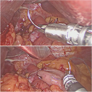 Positioning of the needle in the needle driver.