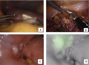 A) Small liver nodule; B) implant in the parietal peritoneum at the left iliac fossa; C) peritoneal nodule in the small intestine; D) fluorescence in small a intestine nodule.
