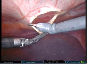 Opening of the posterior lamina of the left rectus sheath.