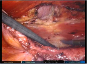 Dissected retromuscular space and hernia defect.