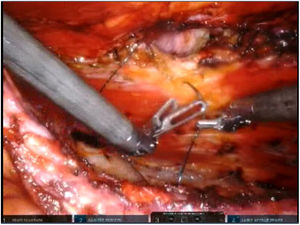 Closure of the hernia defect.