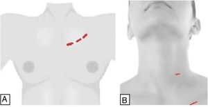 (A) Anterior thoracic approach; (B) cervical and thoracic approaches combined.
